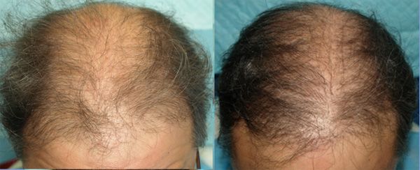 : Class VI genetic hair loss pattern. Patient had previous hair 