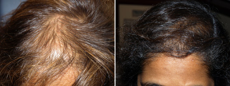 OLYMPUS DIGITAL CAMERA Female Before and After ACell/PRP injections
