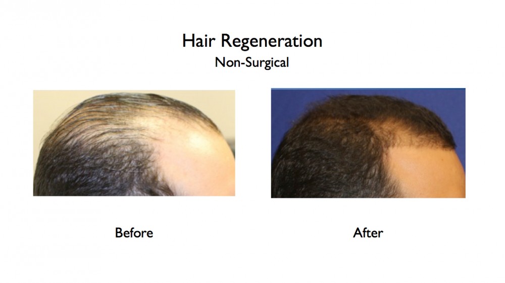 NY Hair Loss Glossary Amiya Prasad M D FACS