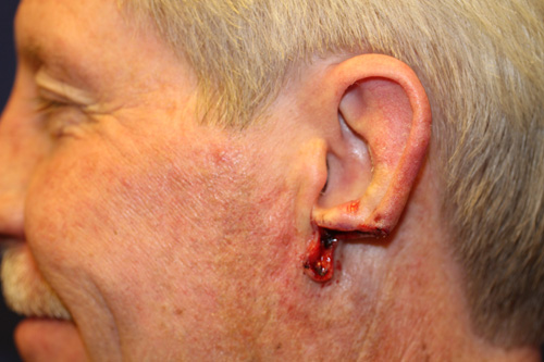 Acell Extracellular Matrix (ECM) Used in Ear Regeneration/Reconstruction Following Cancer. Acell Extracellular Matrix (ECM) Used in Ear Regeneration/Reconstruction