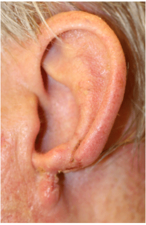 Reconstructive Surgery with Advanced Healing Using ECM Reconstructive Surgery with Advanced Healing Using ECM