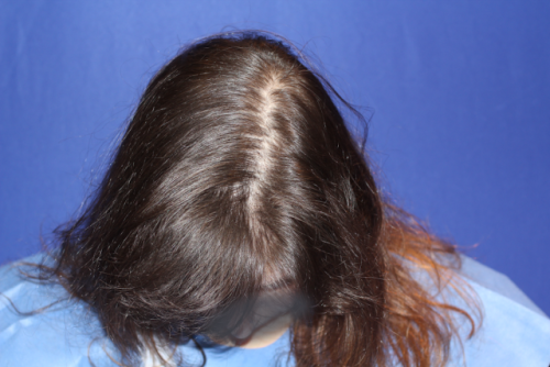 Female Pattern Hair Loss Depression | the psychological effects of balding ny hair loss Female Pattern Hair Loss Depression | the psychological effects of balding ny hair loss