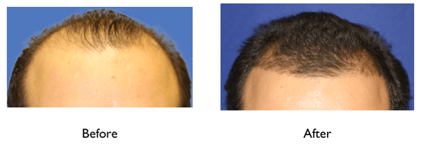 microneedling results hair regeneration Dr Amiya Prasad  NY Hair 