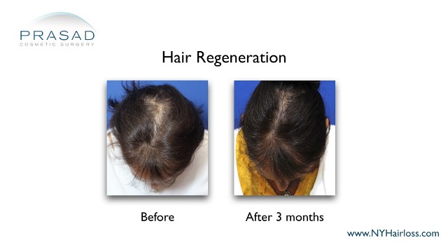 female pattern hair loss 3 months after hair regeneration