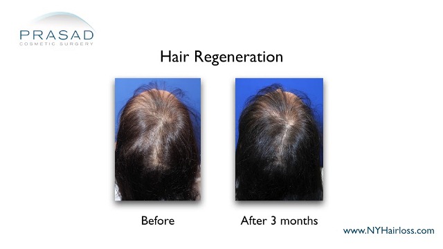 female hair loss 3 months after hair regeneration