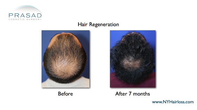 Male pattern hairloss, 7 months after hair regeneration