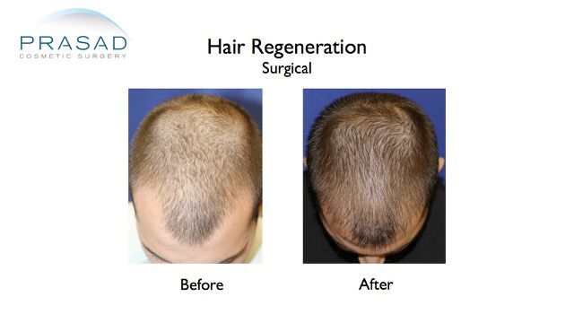 Hair Regeneration Hair Transplant Improvement