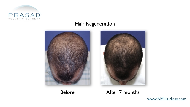 Hair Regeneration before and after 7 months performed by Dr Amiya Prasad
