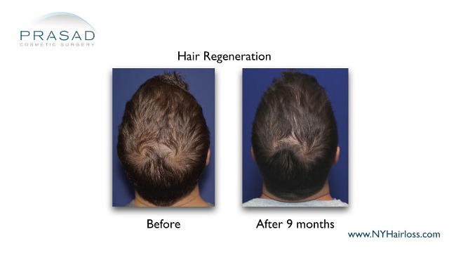 hair regeneration before and after 9 months Dr Amiya Prasad