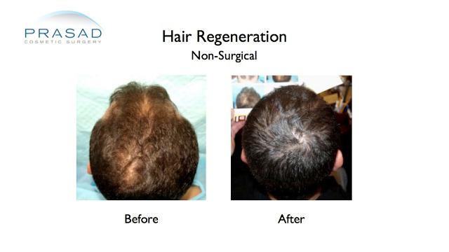 male hairloss before and after hair regeneration