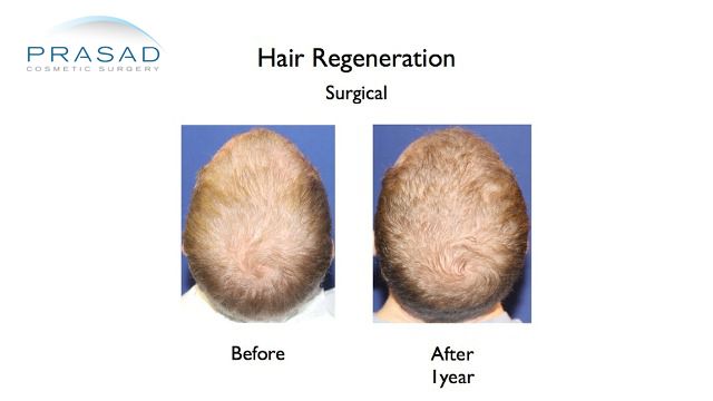 Hair Regeneration Hair Transplant Improvement