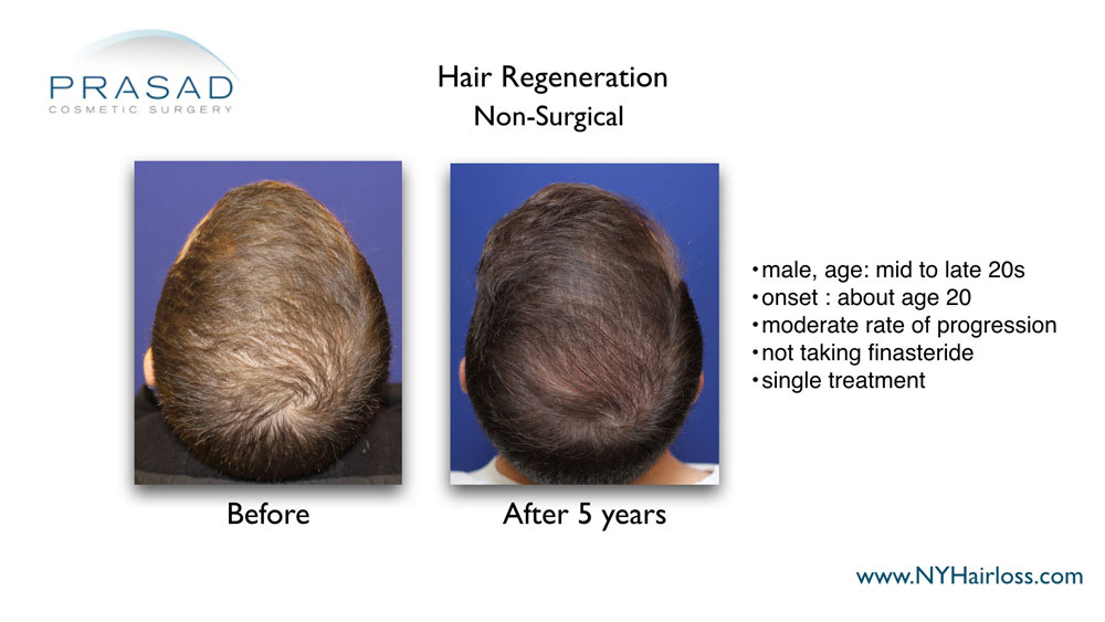 Hair Regeneration ACell PRP male patient with moderate hair thinning 5 years after a single treatment session, without a finasteride