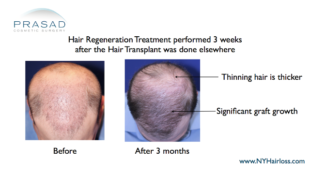 improvement of hair transplant with hair regeneration