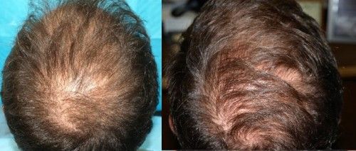 Male Case Study 1 - Before ACell Crown 
