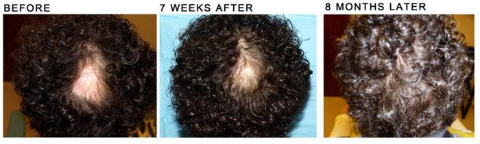 Therapie Alopecia Areata