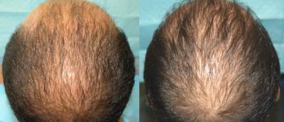 Acell + PRP Injections Before and After