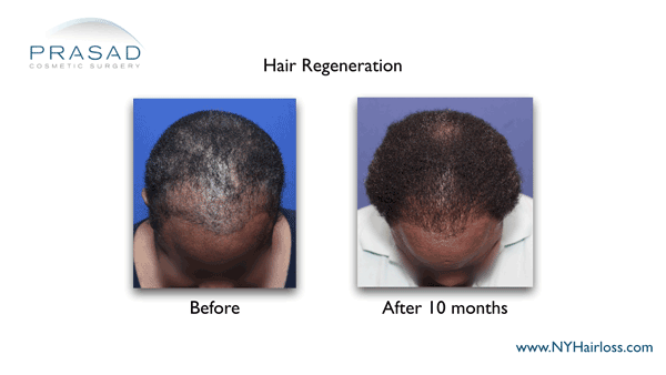african american female hair loss