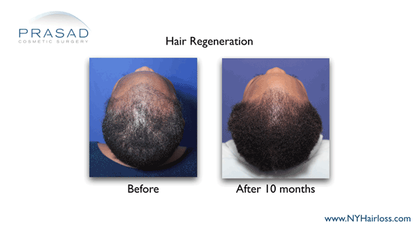 African-American female hair loss treated with Hair Regeneration by Dr Amiya Prasad