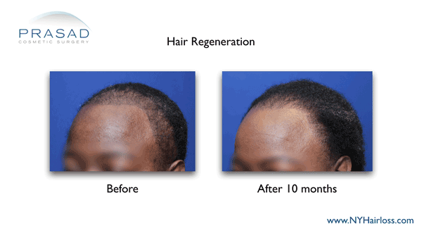 African-American female hair loss treated