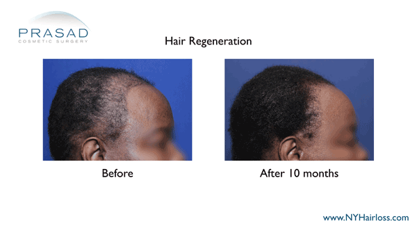 African American female hair loss treated with Hair Regeneration by Dr Amiya Prasad right temple