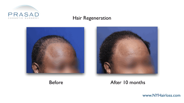 female hair loss treated with Hair Regeneration