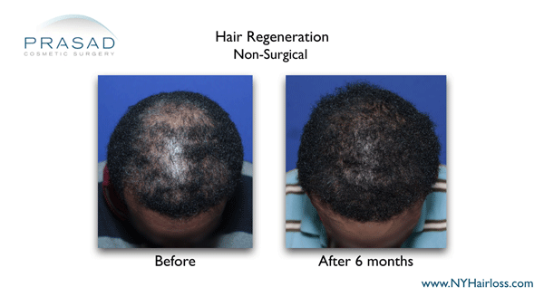 Hair Regeneration on african american female