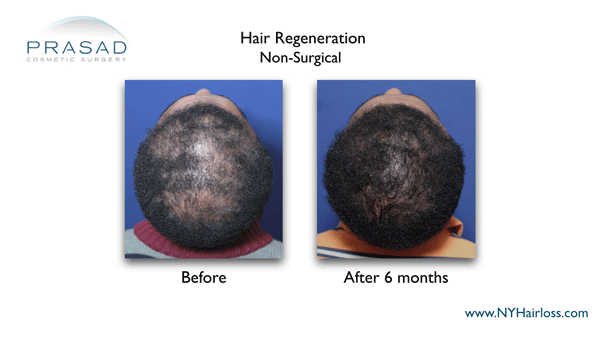African American hair loss after hair regeneration