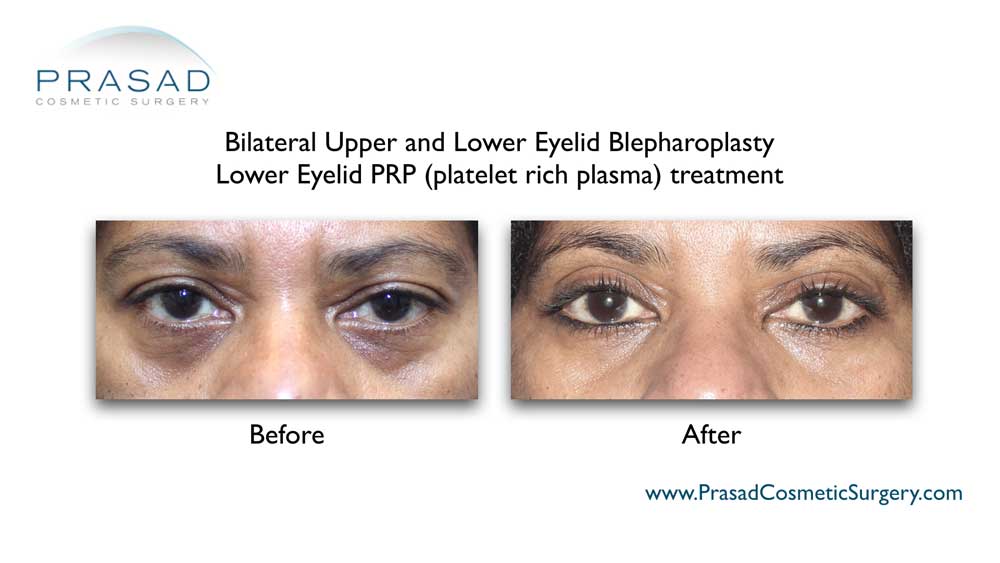 PRP can improve skin quality and surgical healing when applied during upper and/or lower eyelid surgery