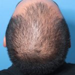 aggressive male pattern hair loss without Finasteride