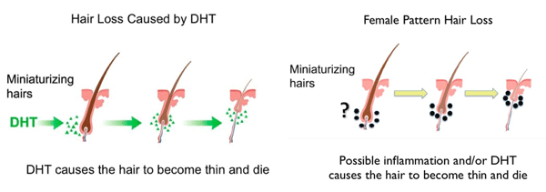 DHT causing hair to thin male and female pattern hair loss illustration