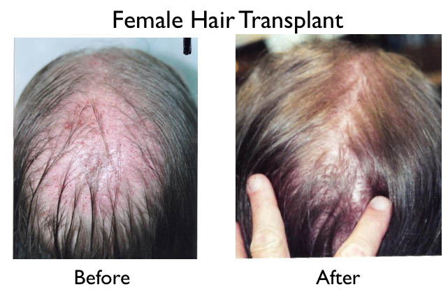 female hair transplant before and after using modern high density grafts