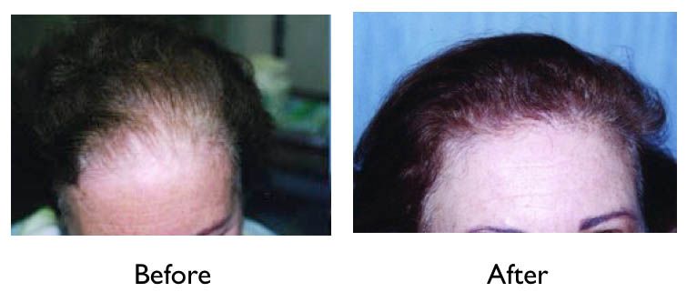 RACGP  Female pattern hair loss