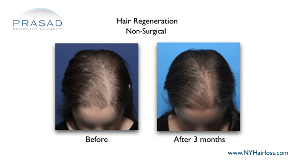 hair regeneration before and after results