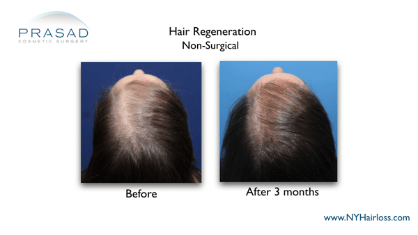 female pattern hair loss before and after hair regeneration
