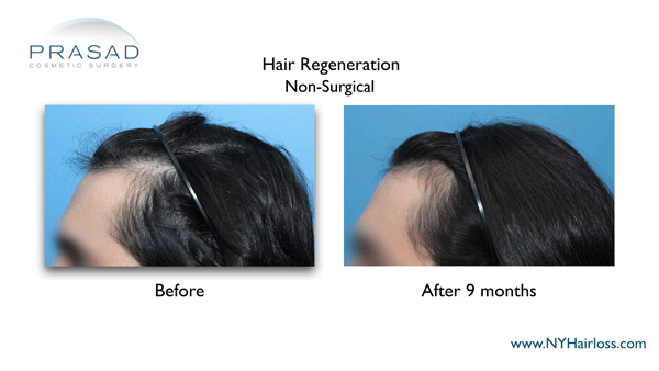 hair loss improved after 9 months