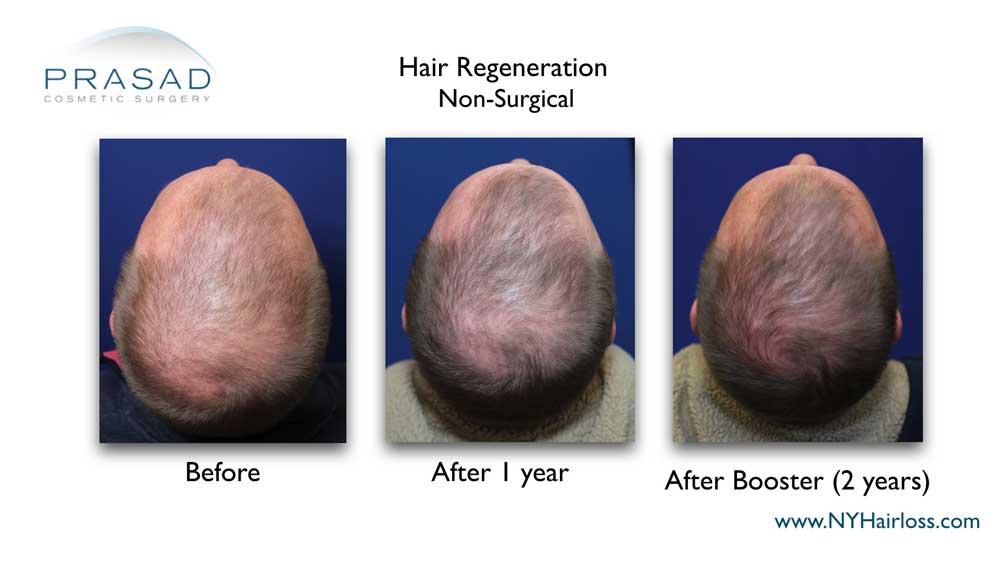 Patients with advanced hair loss are given a second Hair Regeneration treatment 15-24 months after the first, to thicken fine hair growth stimulated by the first treatment, and at no extra charge