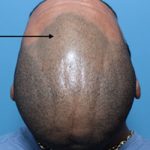 hair loss continuing after scalp micropigmentation