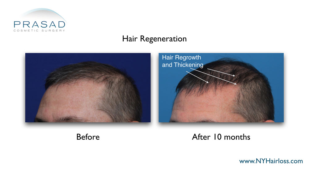 before and 10 months after Hair Regeneration treatment without taking finasteride