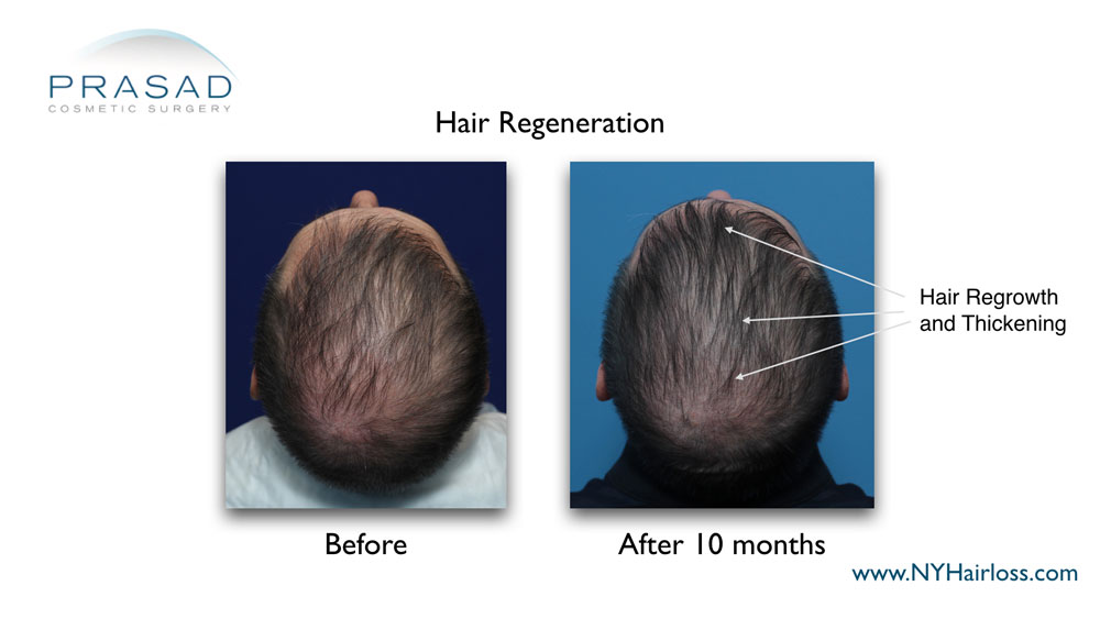 10 months after Hair Regeneration treatment, scalp and crown hair coverage increased