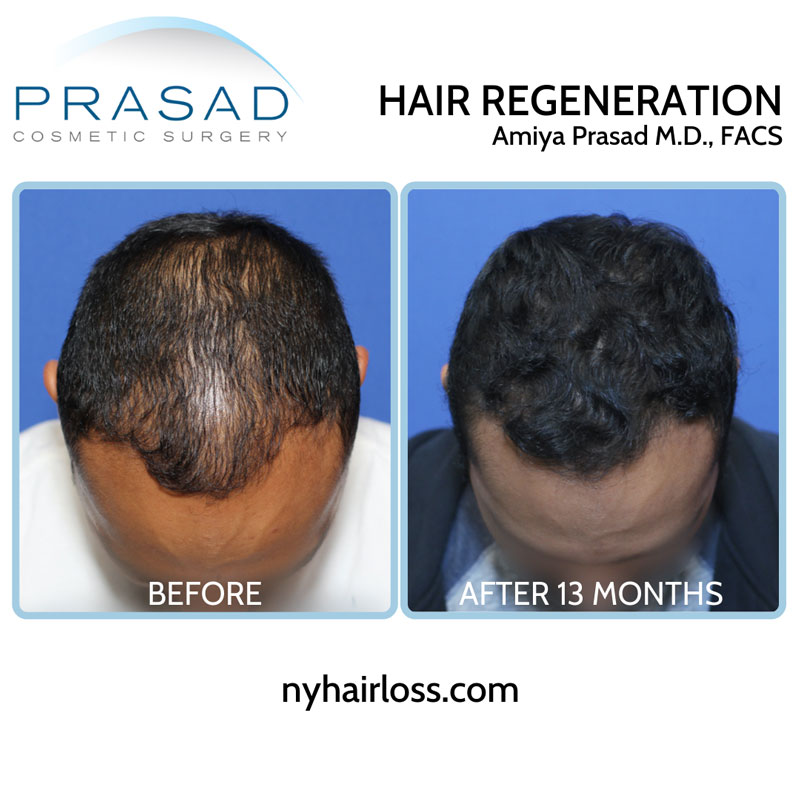 Hair Regeneration Before and After 13 months on male patient