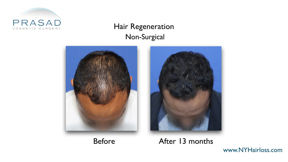 Hair Regeneration Before and After 13 months on male patient