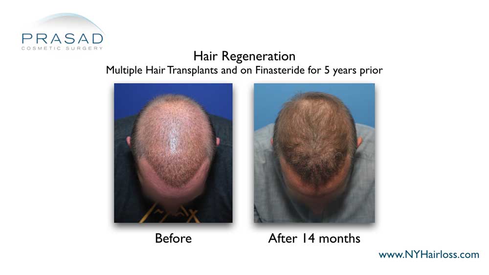 Hair Regeneration is customized individually for patients using factors like age, age on onset of hair loss, gender, prior transplants, and current hair loss medication