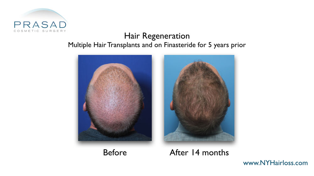 thicker and healthier hair 14 months after hair regeneration treatment