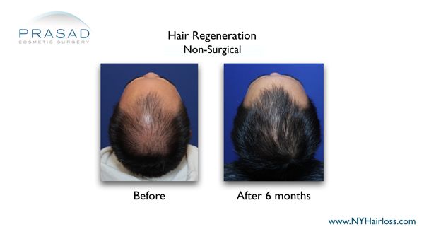 6 months after hair regeneration
