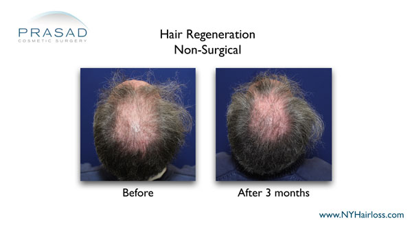 before and after hair regeneration treatment