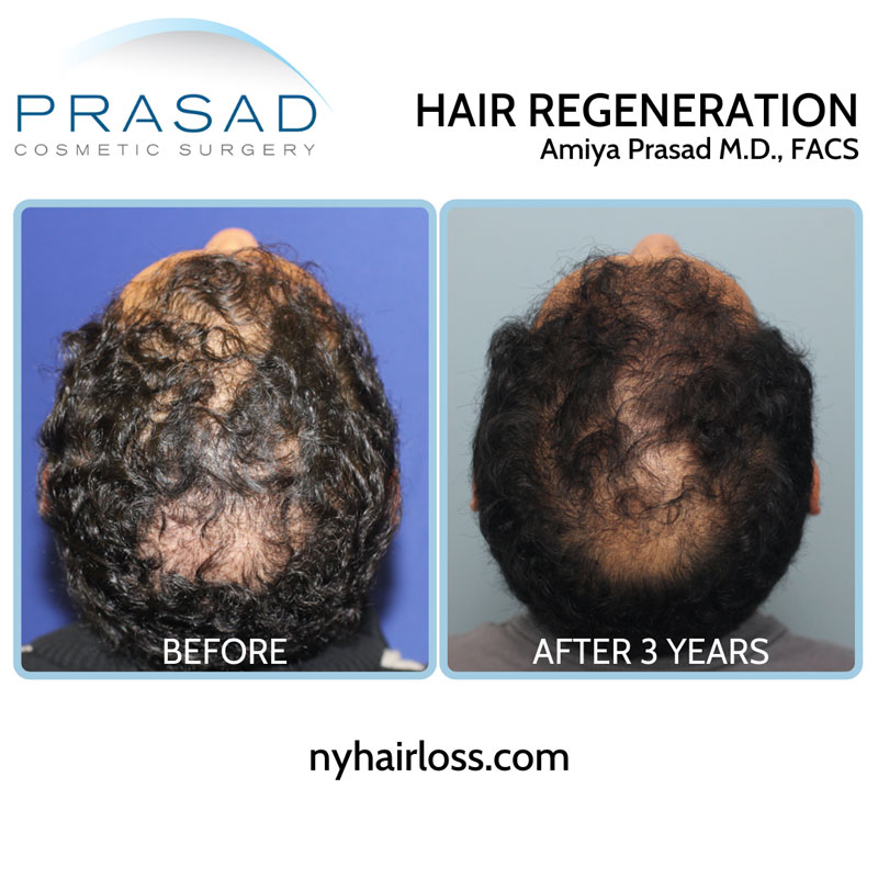 Hair Regeneration PRP ACell is full treatment plan, with the one-time fee covering all follow up appointments