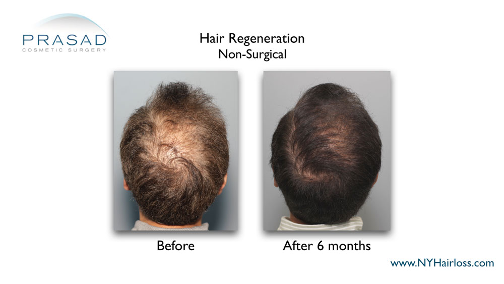 A single Hair Regeneration ACell PRP treatment is effective for most patients, lasting 3-5 years