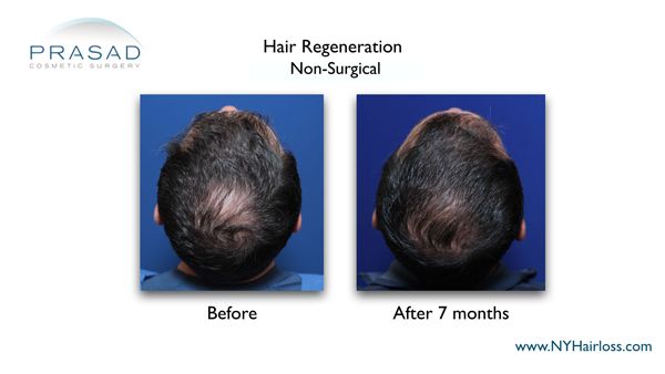 7 months after hair regeneration