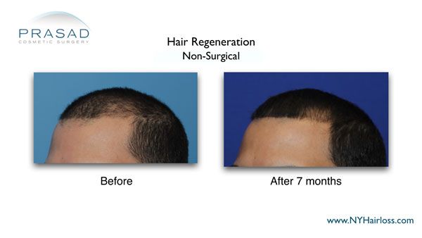 hair regeneration before and after