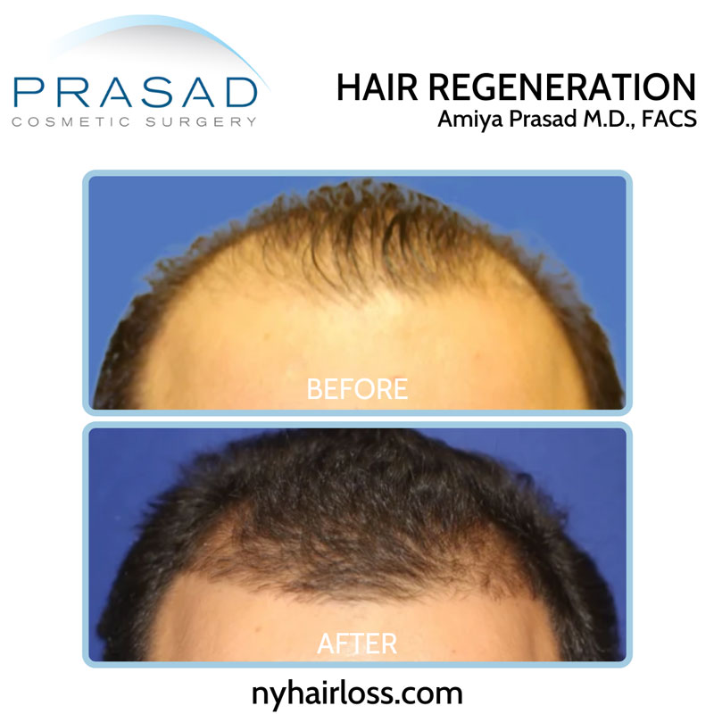 One of our original Hair Regeneration ACell PRP patients dating back to 2011